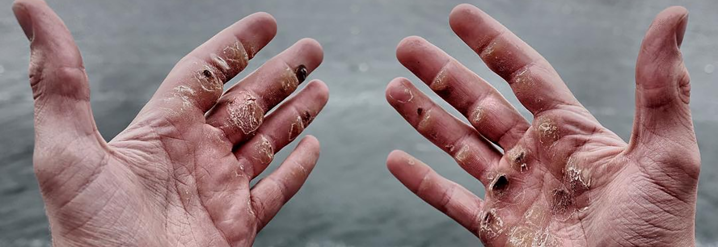 heavily callused hands