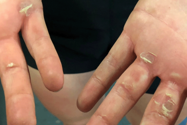 blistered hands